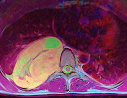 невринома акс в цвете