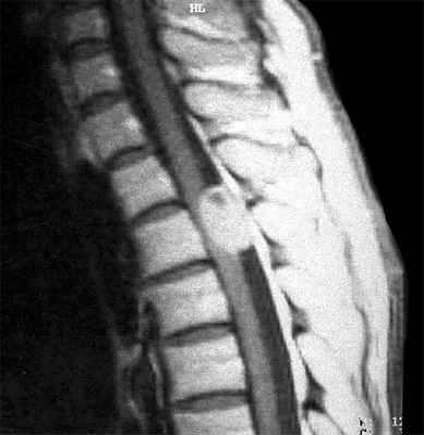 менингиома-контр