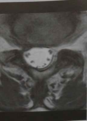 Снимки МРТ и КТ. Арахноидит