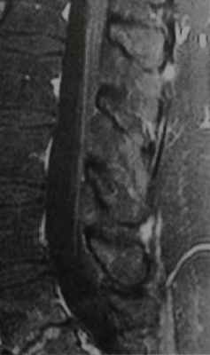 Снимки МРТ и КТ. Арахноидит