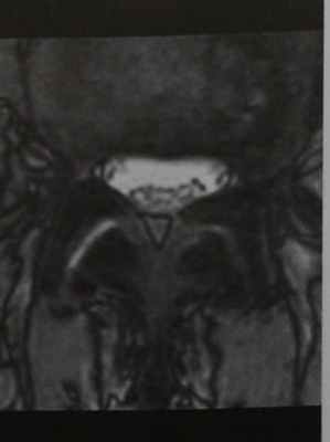 Снимки МРТ и КТ. Арахноидит