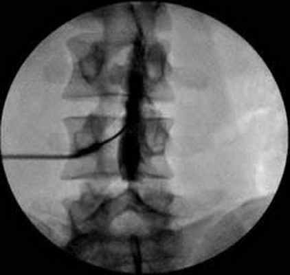 Контрастное вещество, видимое при миелографии, вводится в субдуральное пространство посредством люмбальной пункции.