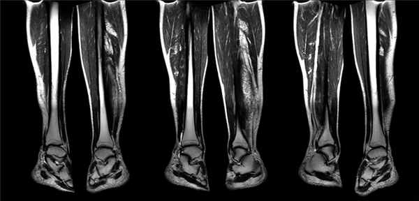 МРТ нижних конечностей