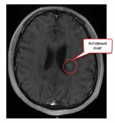 Активный очаг - рис 2