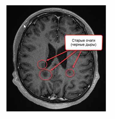Старые очаги (черные дыры)
