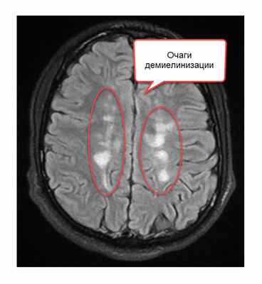 Очаги демиелинизации - рис 2