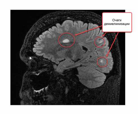 Очаги демиелинизации - рис 3