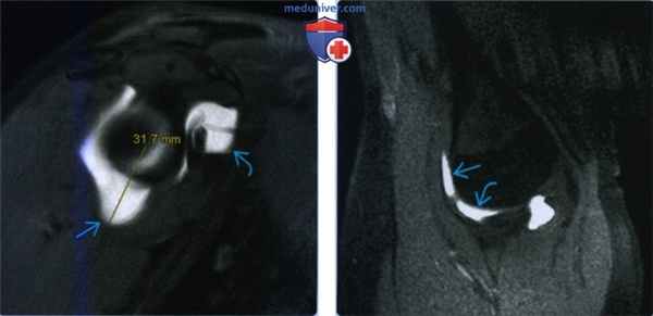 Признаки разнонаправленной нестабильности плечевого сустава