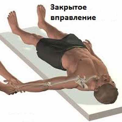 Нестабильность плечевого сустава