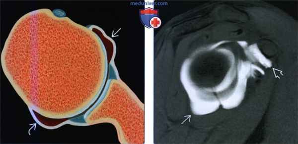 Признаки разнонаправленной нестабильности плечевого сустава