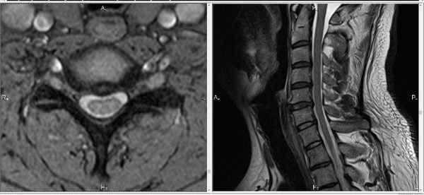 МРТ шеи. МРТ шейного отдела позвоночника