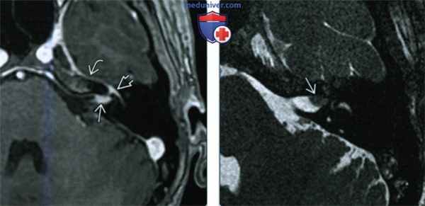 Синдром Рамсея Ханта (СРХ) - лучевая диагностика