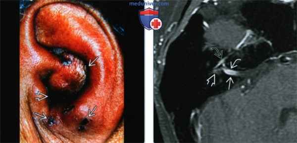 Синдром Рамсея Ханта (СРХ) - лучевая диагностика