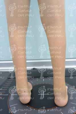 Синдром каудальной регрессии: причины и наиболее распространенные аномалии