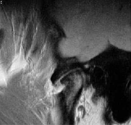 МРТ височно-нижнечелюстных суставов в диагностике заболеваний ВНЧС