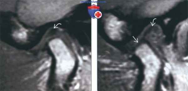 Лучевая диагностика спаек височно-нижнечелюстного сустава