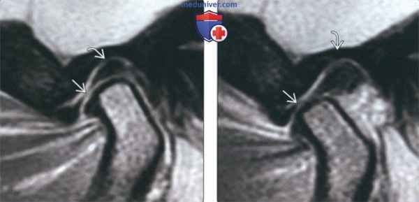 Лучевая диагностика спаек височно-нижнечелюстного сустава