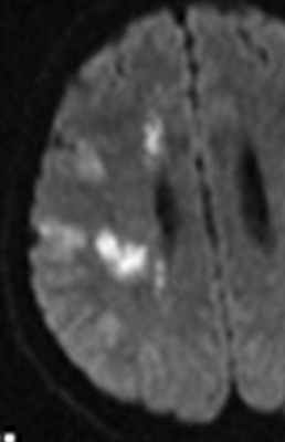 вазоспазм при САК