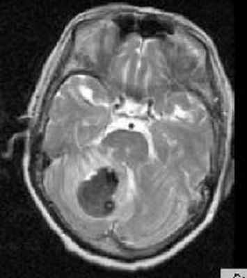 геморрагический инсульт