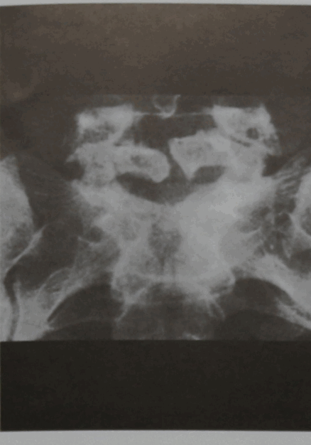 Снимки МРТ и КТ. Менингоцеле / Миеломенингоцеле