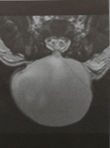 Снимки МРТ и КТ. Менингоцеле / Миеломенингоцеле