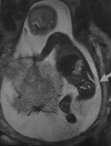 Снимки МРТ и КТ. Менингоцеле / Миеломенингоцеле