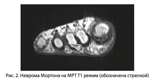 Рис. 2. Неврома Мортона на МРТ T1