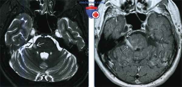 Тригеминальная невралгия - лучевая диагностика