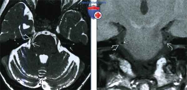 Тригеминальная невралгия - лучевая диагностика