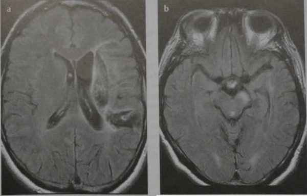 Снимки МРТ и КТ. Валлеровская дегенерация