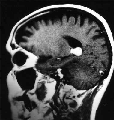 внутирижел-контр-саг