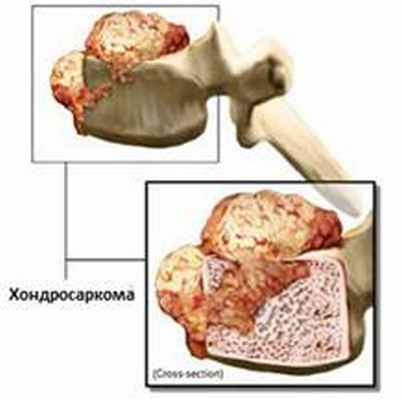 Опухоли позвоночника