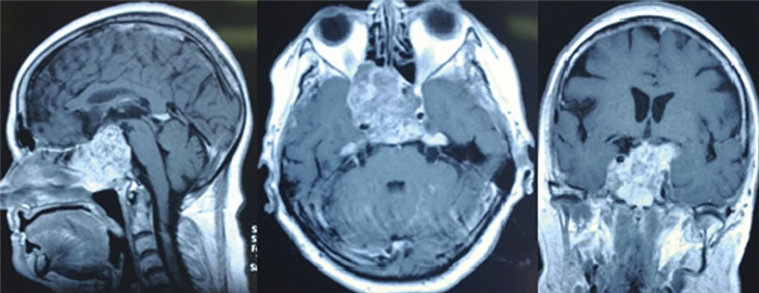 Хордома в черепе