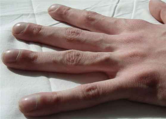 Муковисцидоз