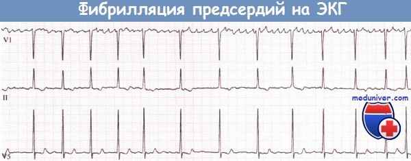 трепетание предсердий