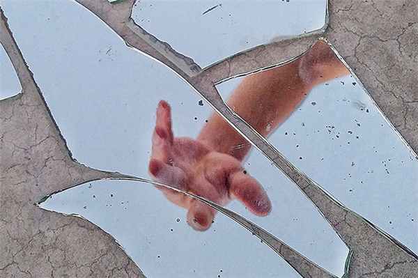 Хотя лекарств от нарциссизма еще не придумали, положительный эффект оказывает психотерапия