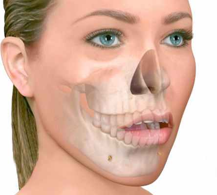 Открытый прикус