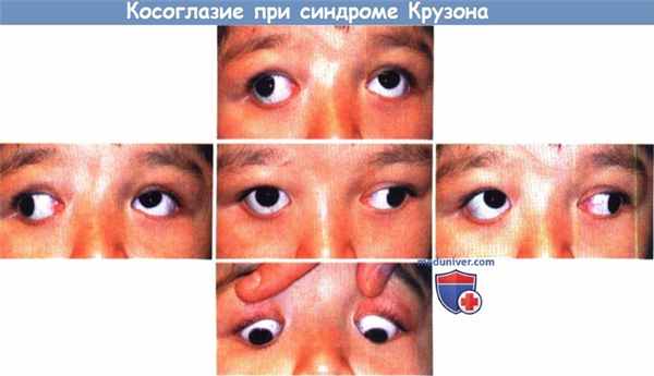 Косоглазие при синдроме Крузона у ребенка
