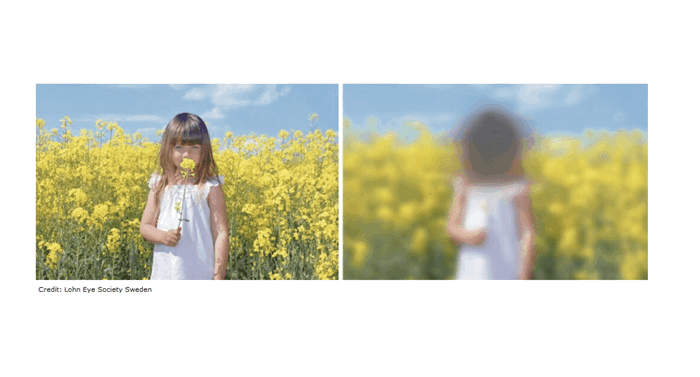 Наследственная Оптическая Нейропатия Лебера