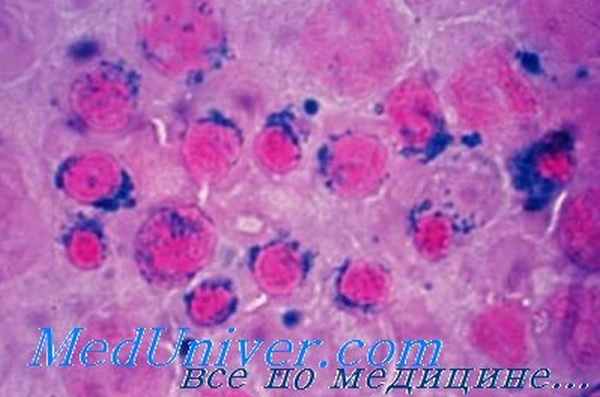 сидеробластическая анемия