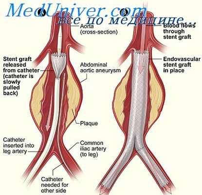 врожденные аневризмы артерий