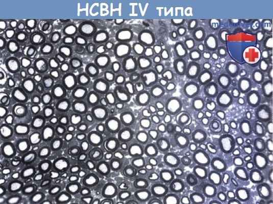 Наследственная сенсорная и вегетативная невропатия (НСВН) IV типа (врожденная нечувствительность к боли с ангидрозом)