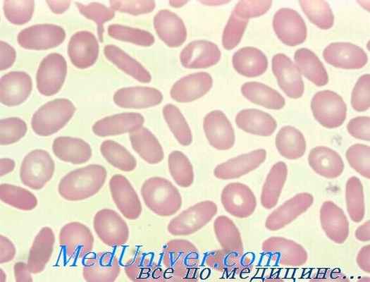 мазок при наследственном овалоцитозе