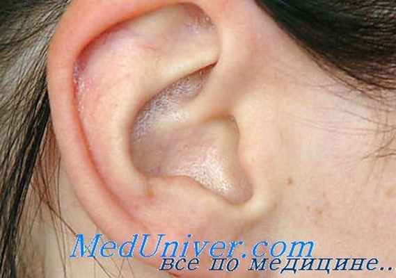 рецессивная тугоухость