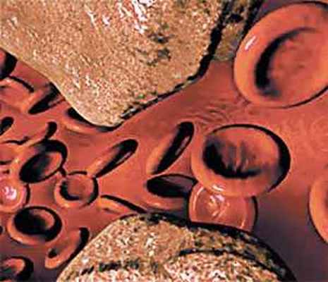 Возрастные изменения артерий. Атеросклероз