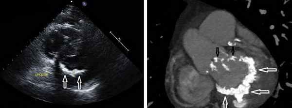 Кальциноз митрального клапана