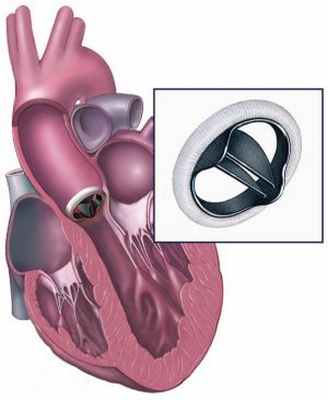 Аортальный клапан