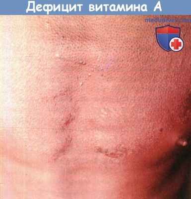 Кожа при дефиците витамина А