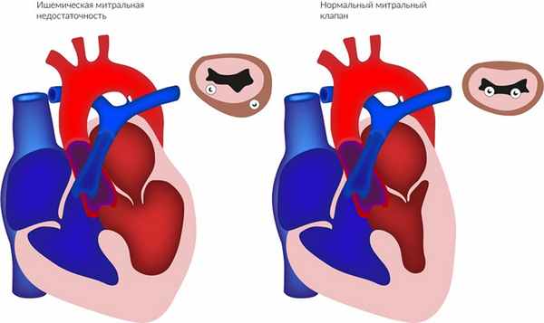 mitralnaya_nedostatochnost.jpg