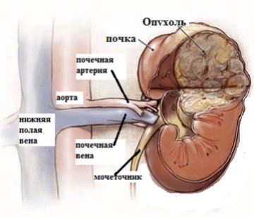 эмбриональная нефробластома почек
